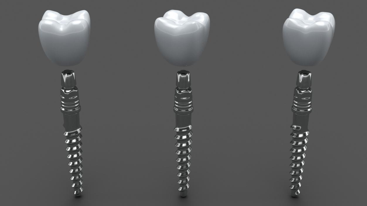 Tooth Implants Collection 3 3D