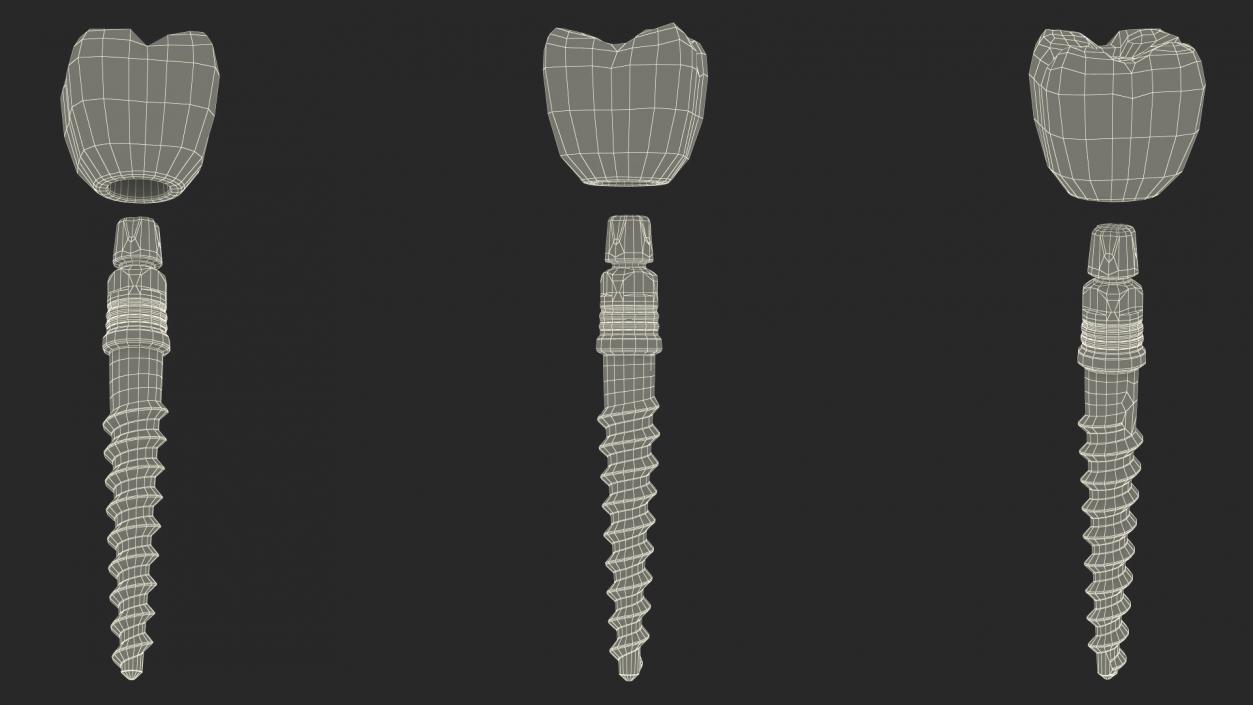 Tooth Implants Collection 3 3D