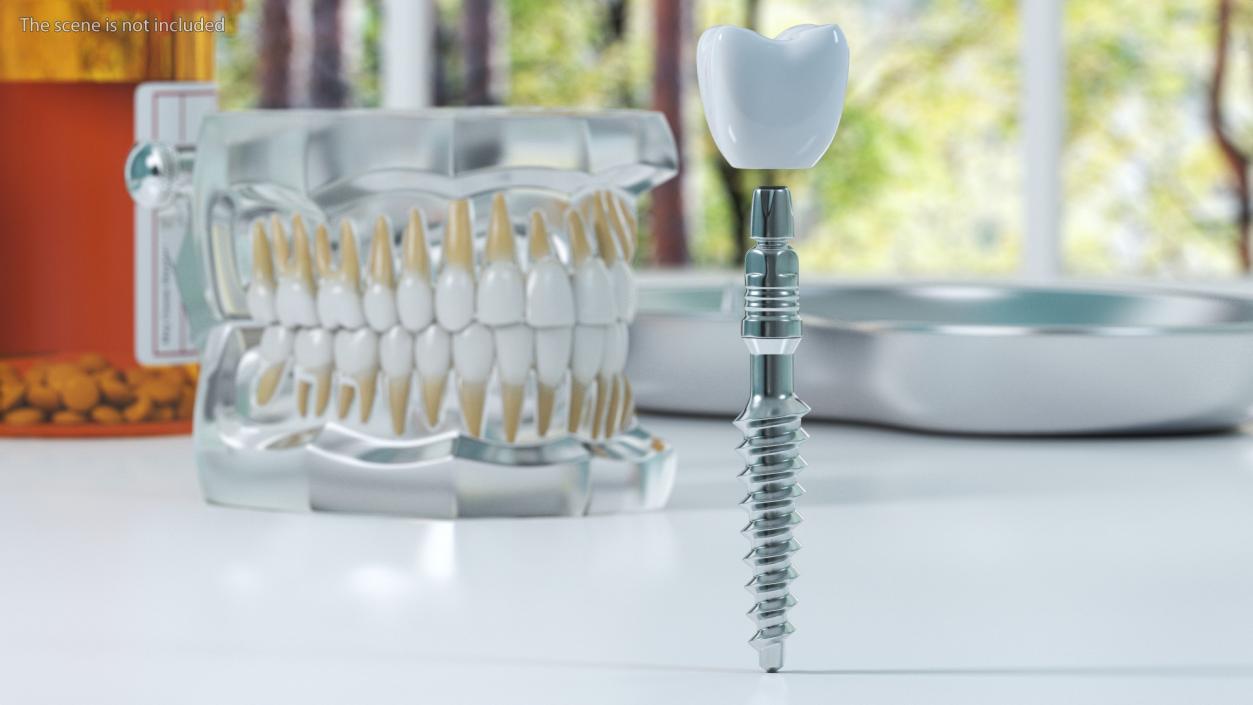 Tooth Implants Collection 3 3D