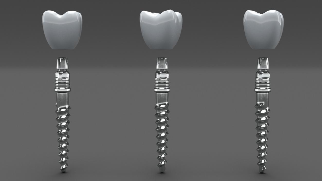 Tooth Implants Collection 3 3D