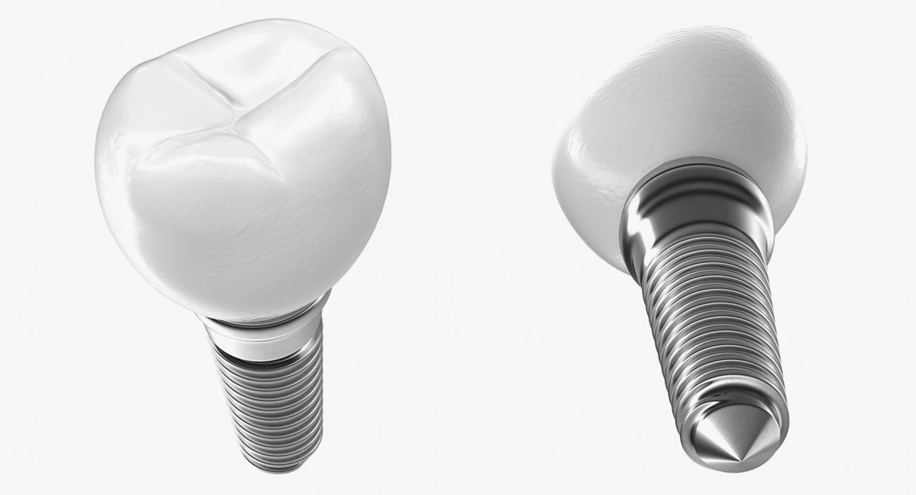 Tooth Implants Collection 3 3D