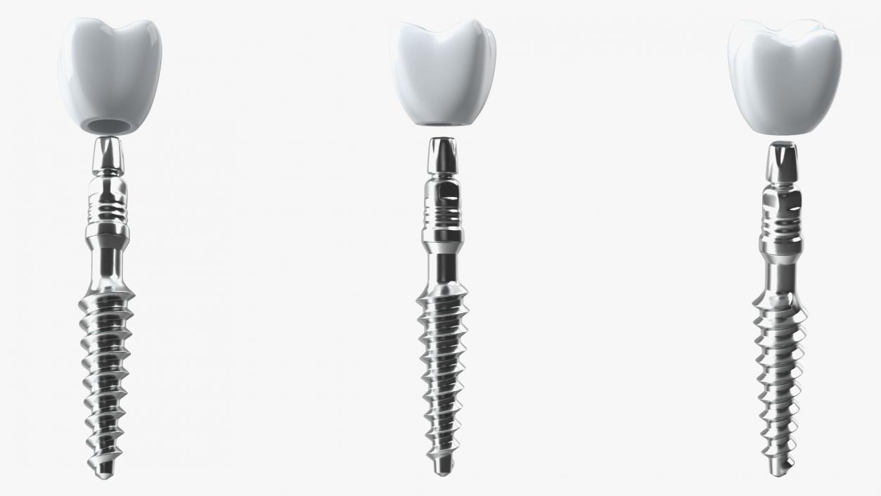 Tooth Implants Collection 3 3D