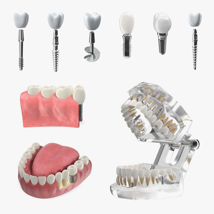 Tooth Implants Collection 3 3D