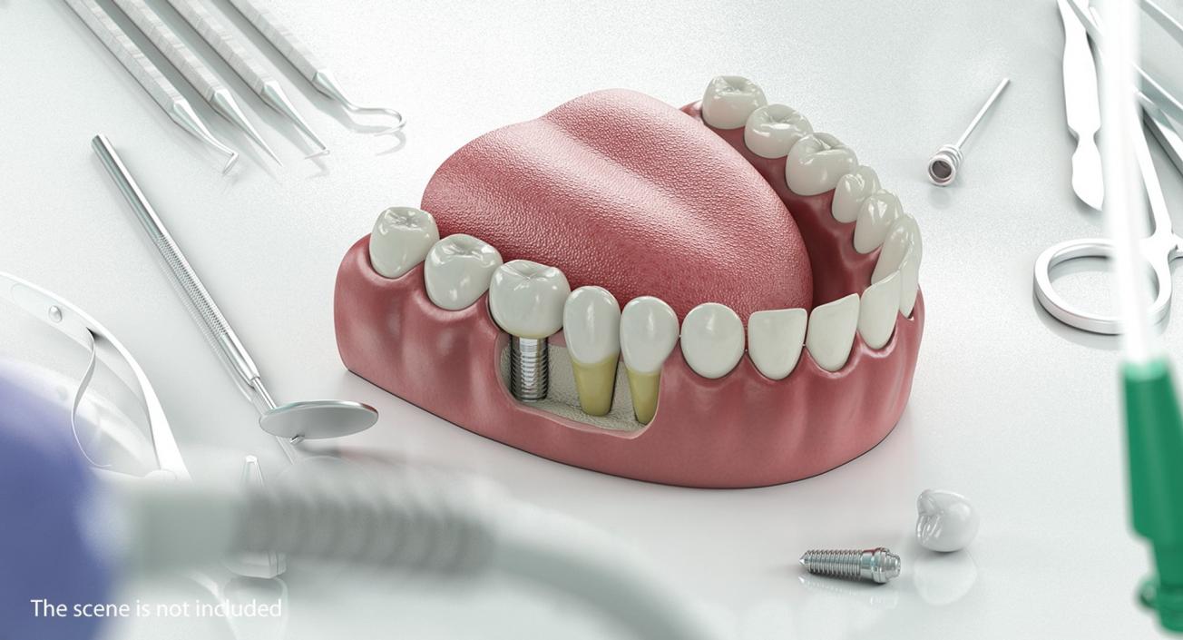 Tooth Implants Collection 3 3D