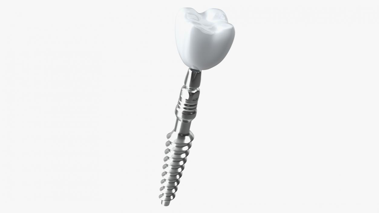 Tooth Implants Collection 3 3D