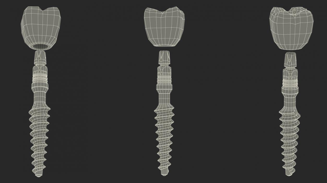 Tooth Implants Collection 3 3D