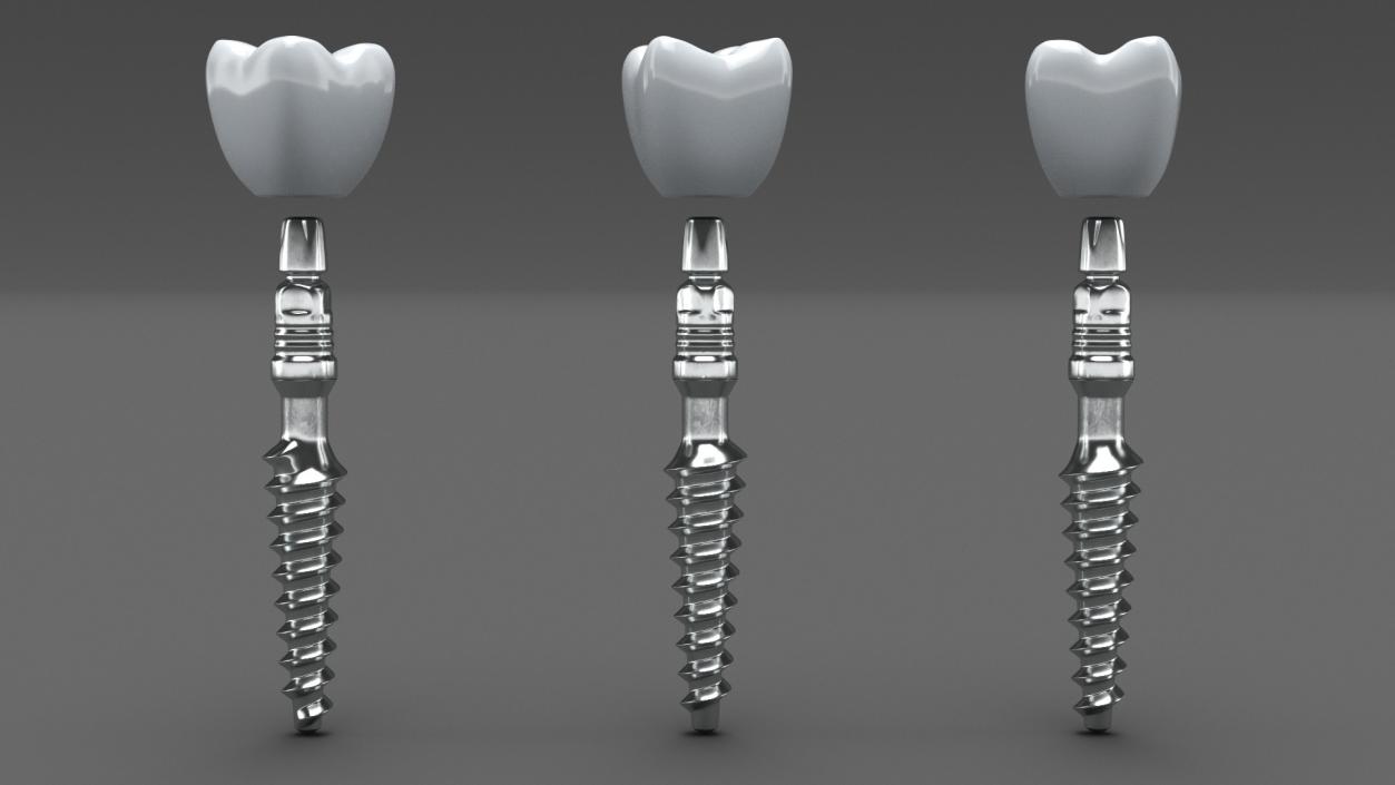 Tooth Implants Collection 3 3D