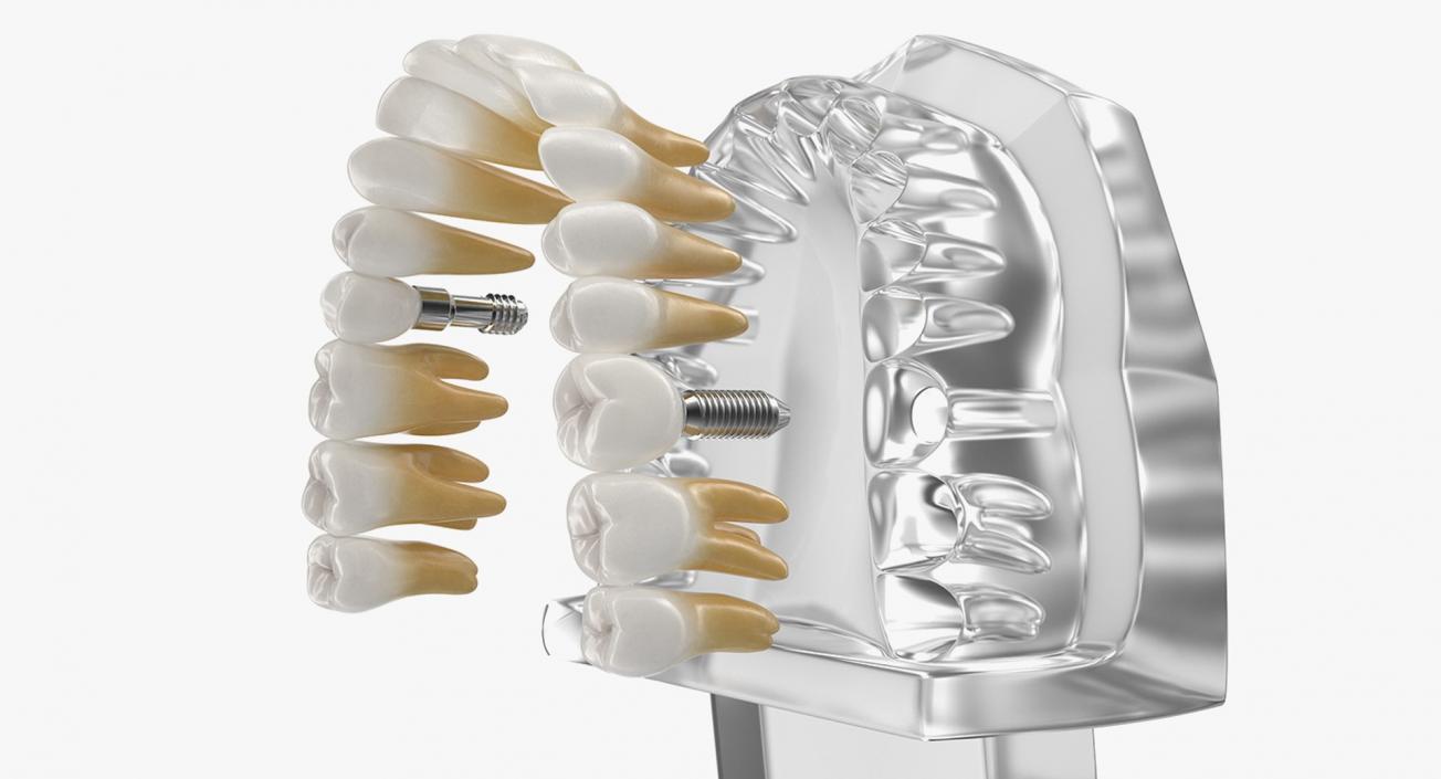 Tooth Implants Collection 3 3D