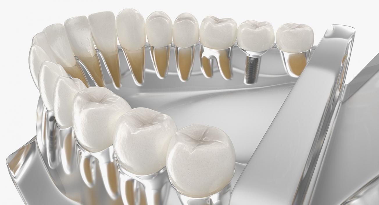 Tooth Implants Collection 3 3D