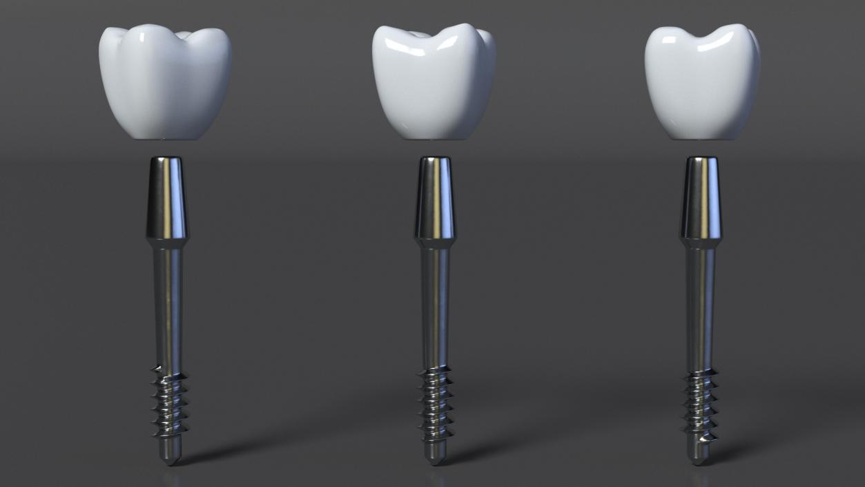 Tooth Implants Collection 3 3D