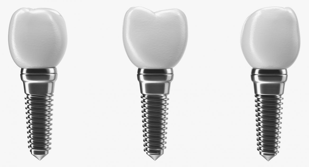 Tooth Implants Collection 3 3D