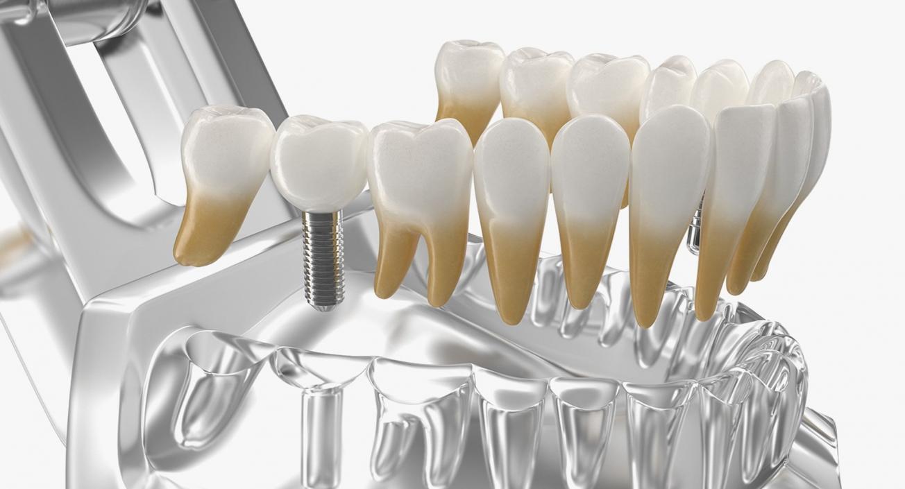 Tooth Implants Collection 3 3D