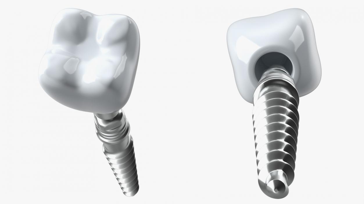 Tooth Implants Collection 3 3D