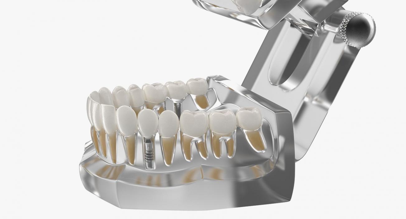 Tooth Implants Collection 3 3D