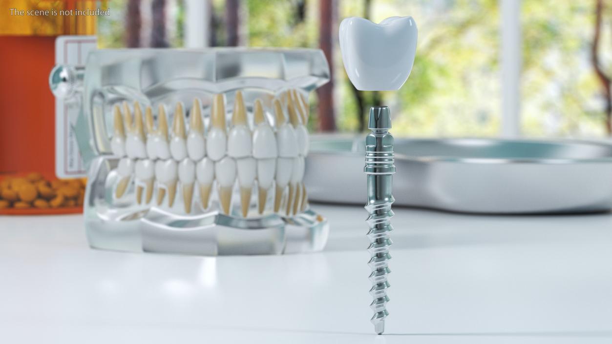 Tooth Implants Collection 3 3D