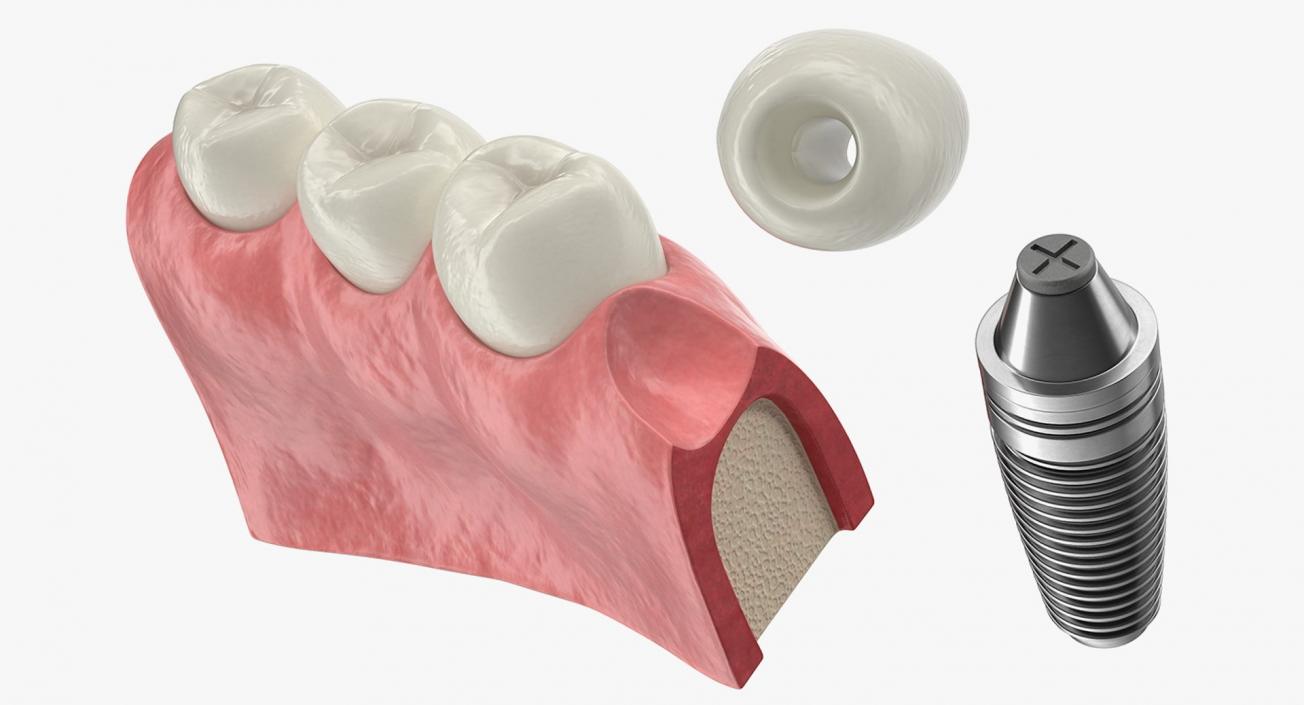 Tooth Implants Collection 3 3D