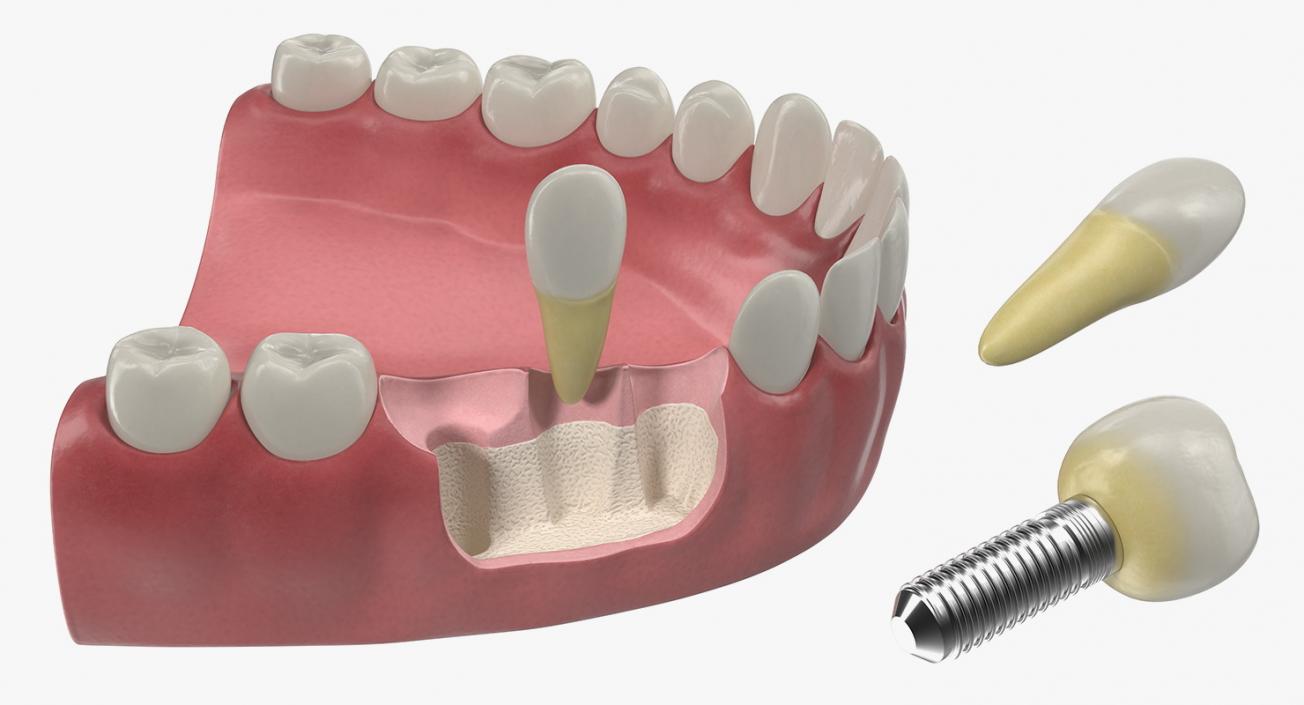 Dental Collection 5 3D model