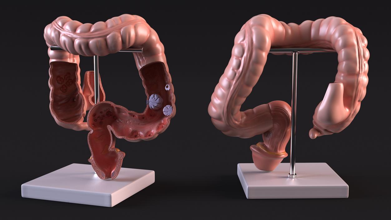 Medical Model Diseased Intestine 3D