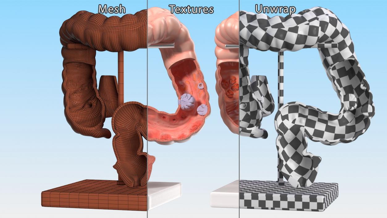 Medical Model Diseased Intestine 3D