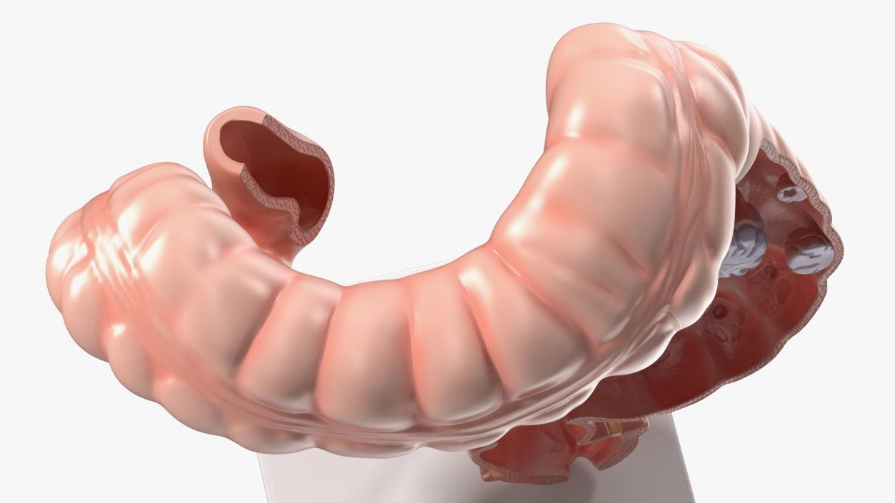 Medical Model Diseased Intestine 3D