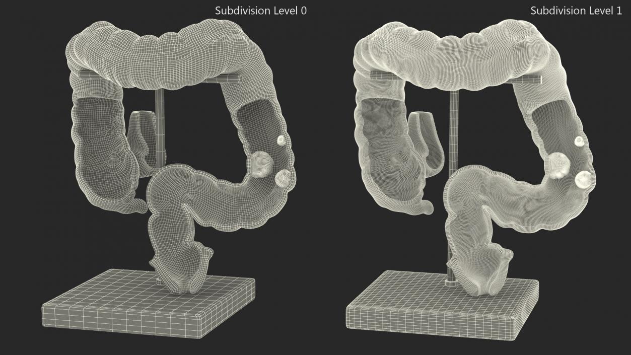 Medical Model Diseased Intestine 3D