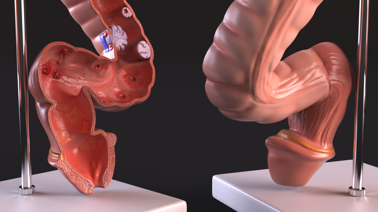 Medical Model Diseased Intestine 3D