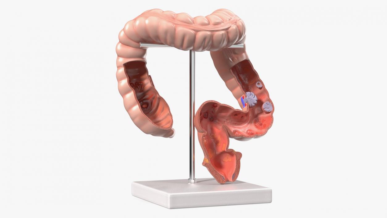 Medical Model Diseased Intestine 3D