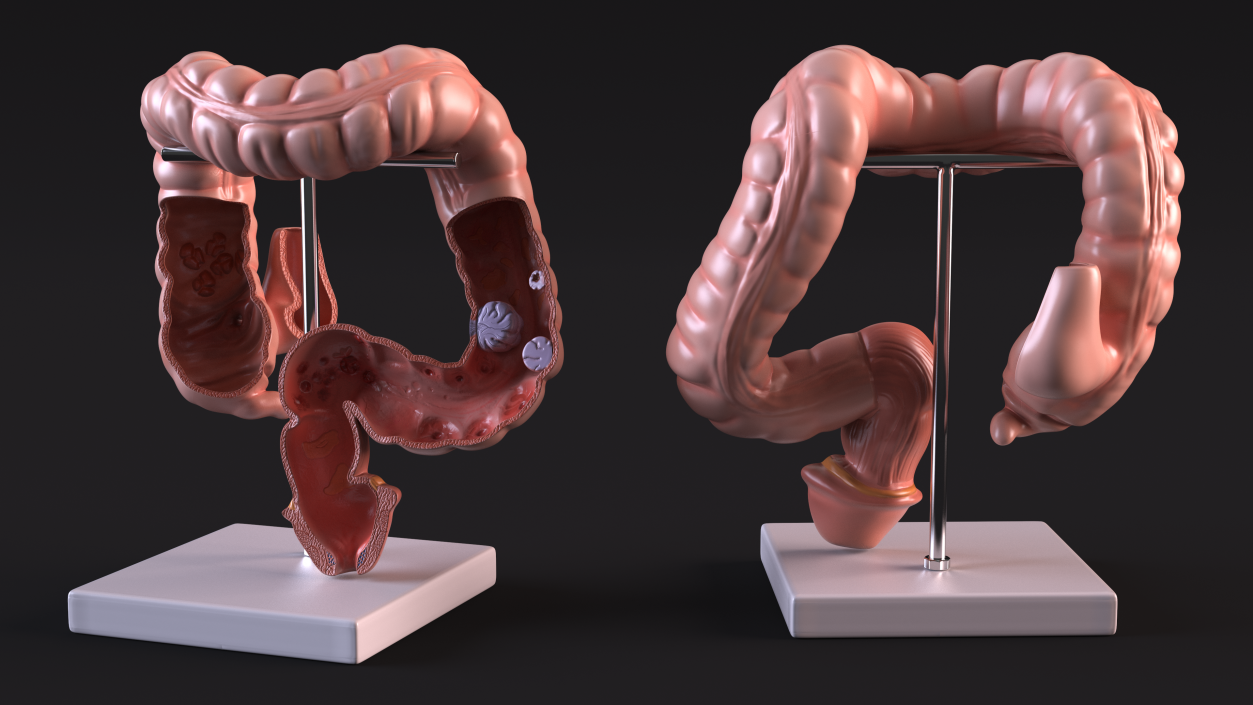 Medical Model Diseased Intestine 3D