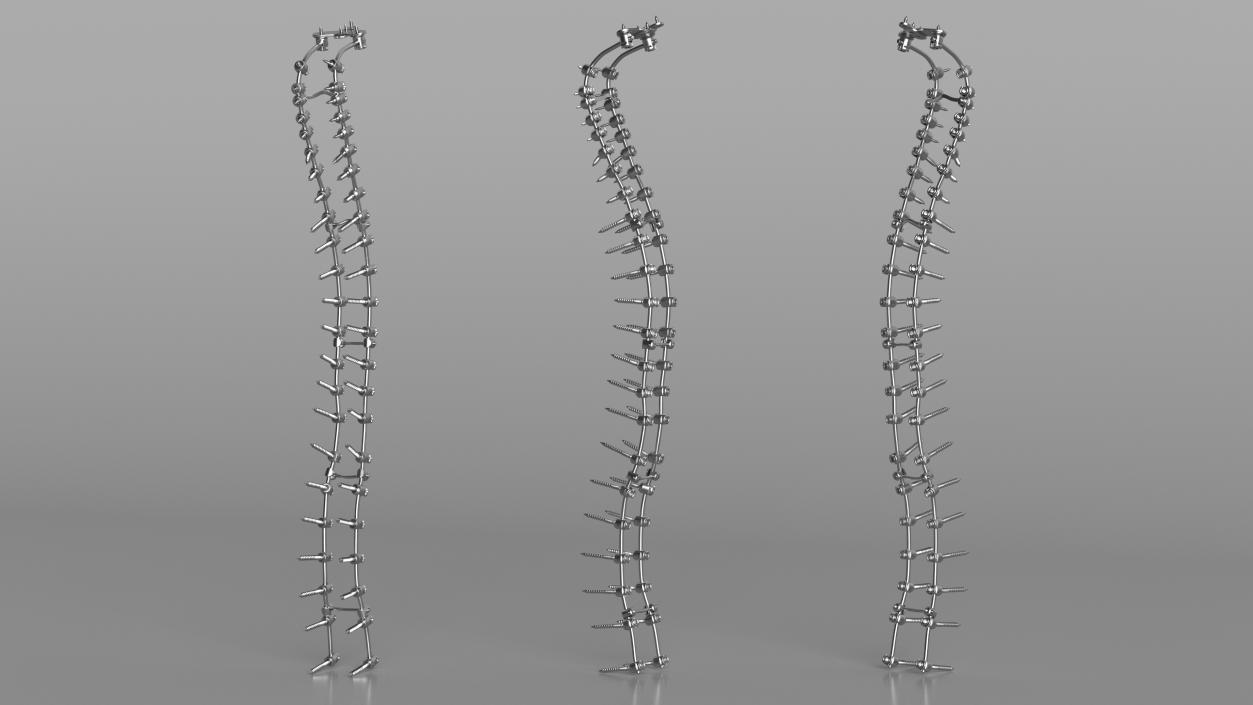 3D Spine Fixation System