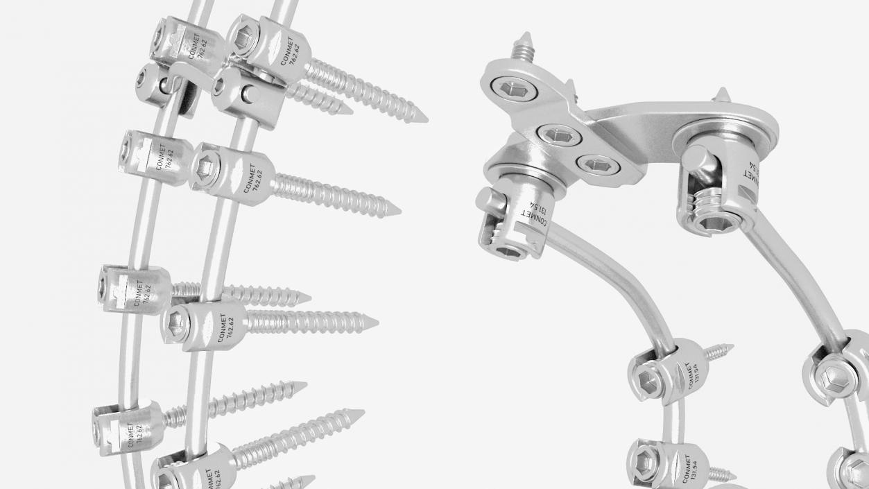 3D Spine Fixation System