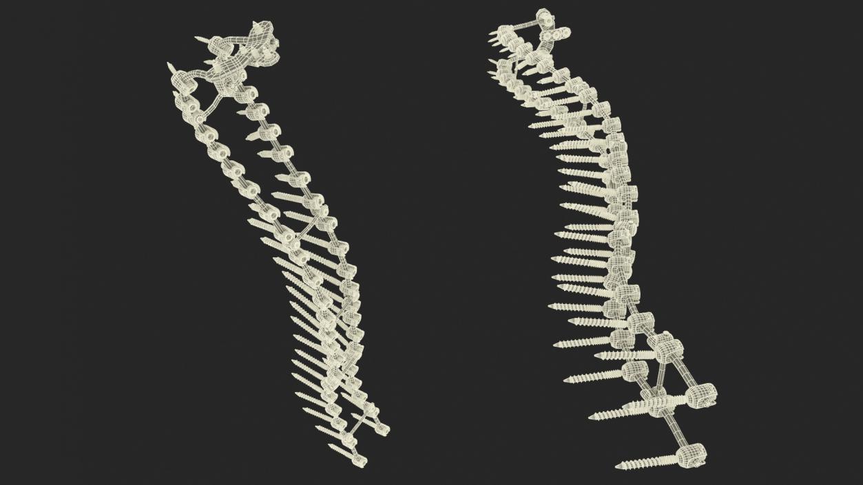 3D Spine Fixation System