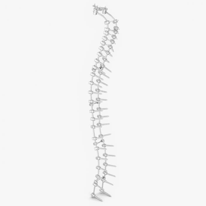 3D Spine Fixation System