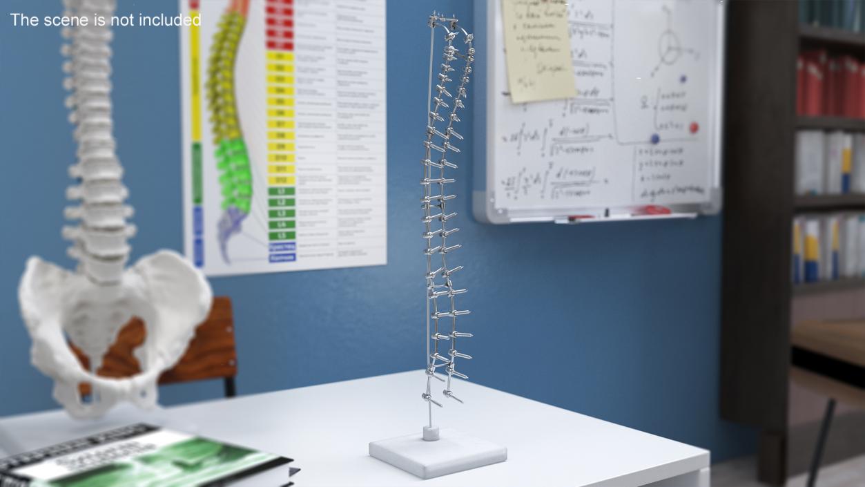 3D Spine Fixation System