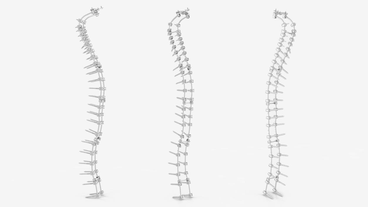 3D Spine Fixation System