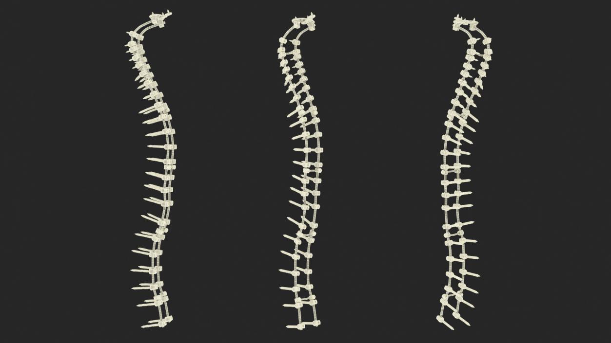 3D Spine Fixation System