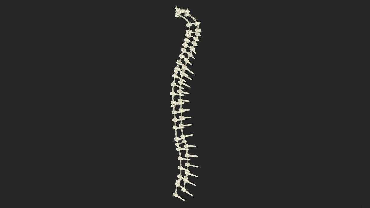 3D Spine Fixation System