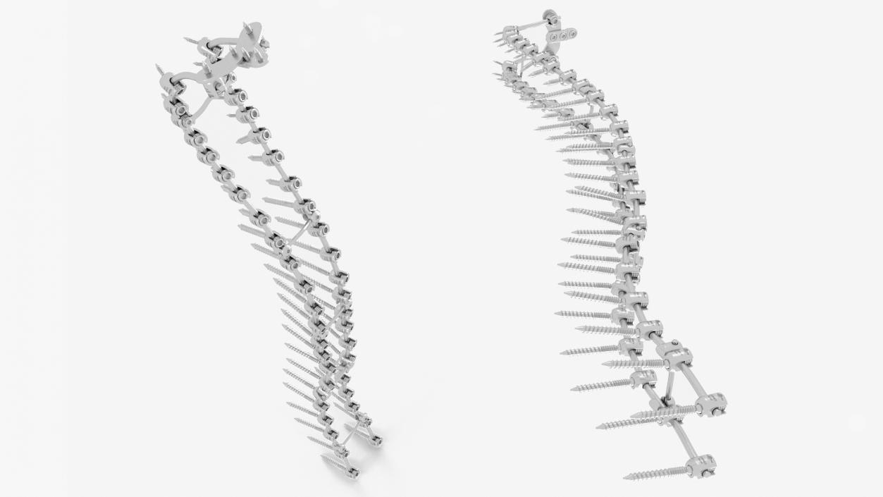 3D Spine Fixation System