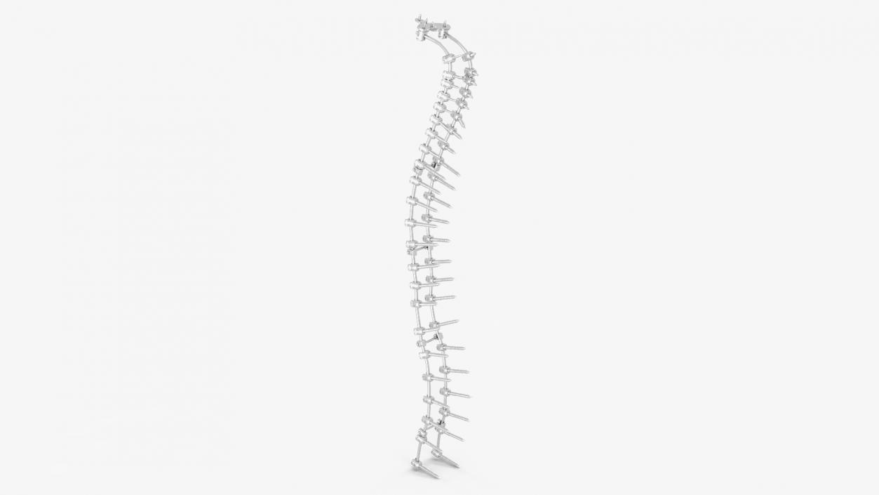 3D Spine Fixation System