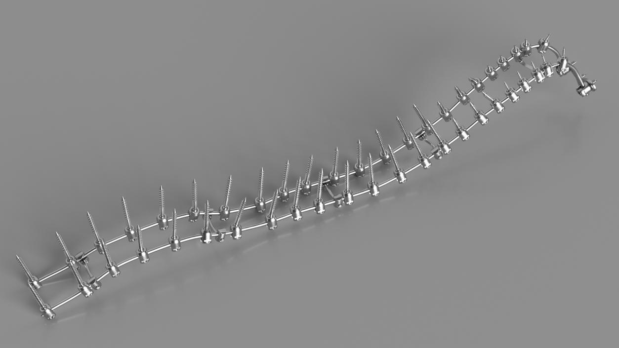 3D Spine Fixation System