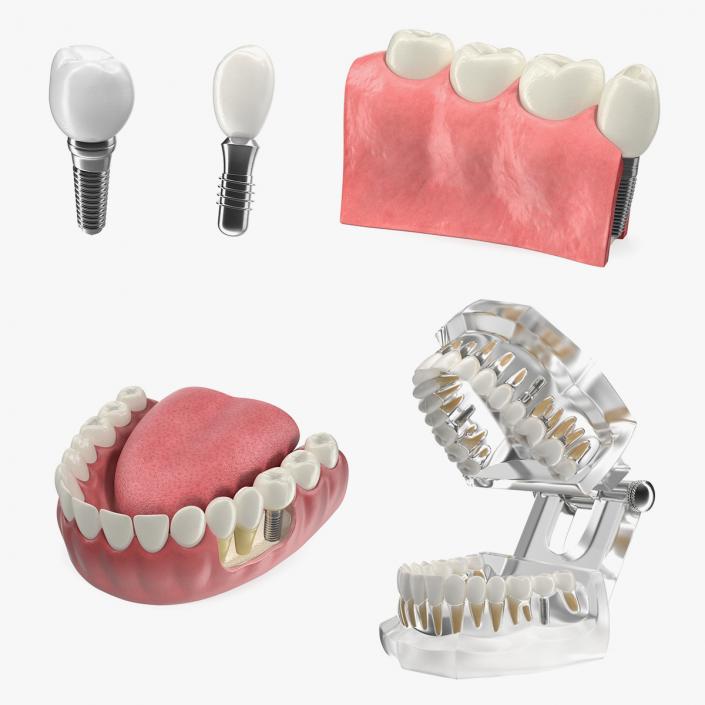 3D model Tooth Implants Collection