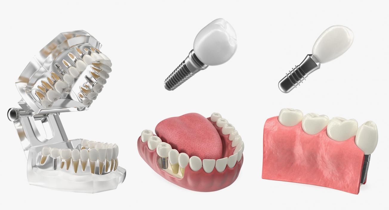 3D model Tooth Implants Collection