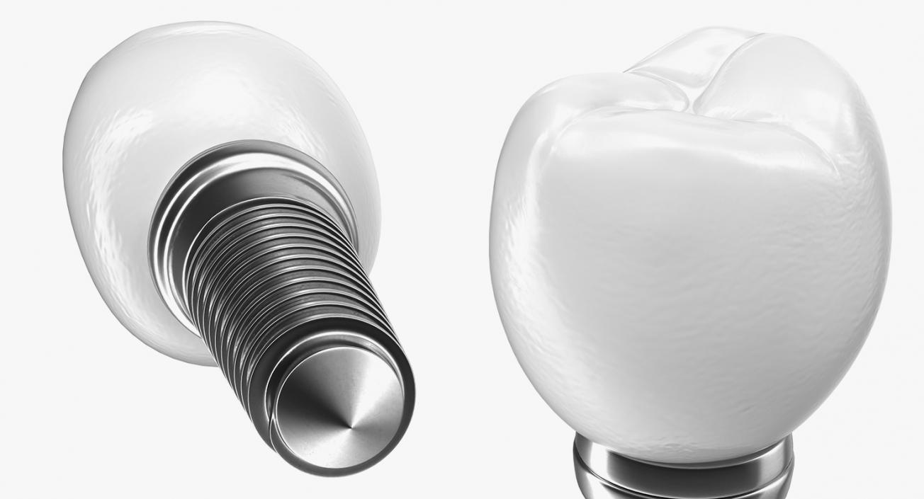 3D model Tooth Implants Collection