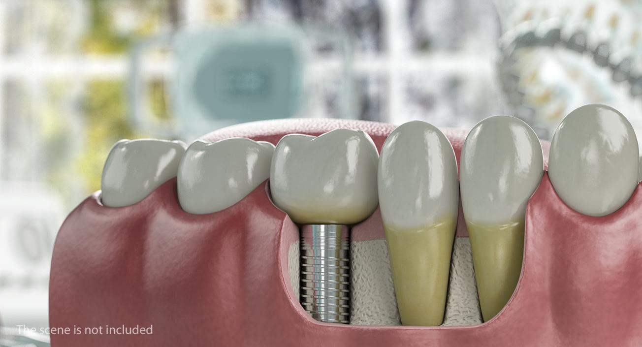 3D model Tooth Implants Collection