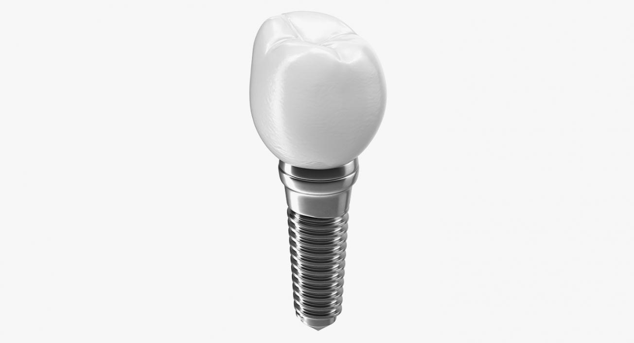 3D model Tooth Implants Collection