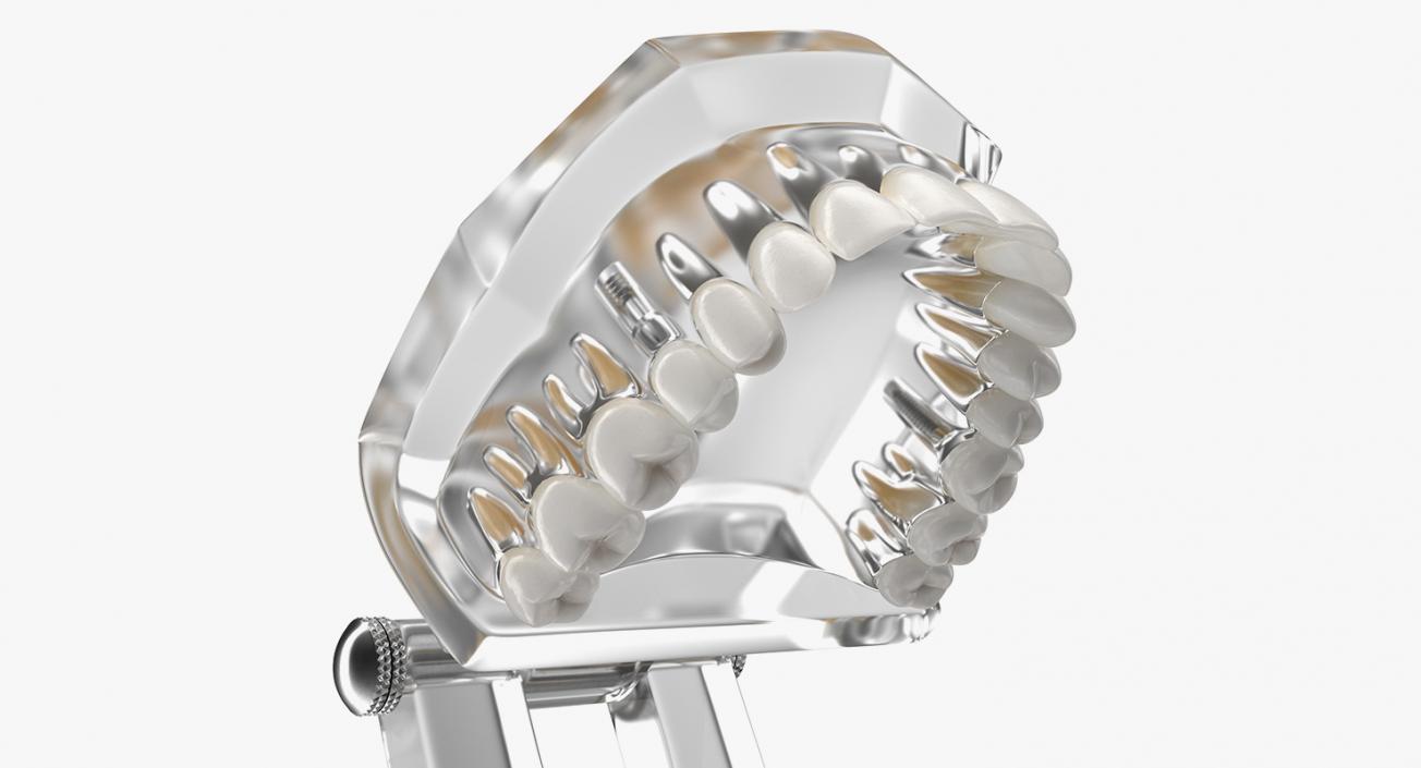 3D model Tooth Implants Collection