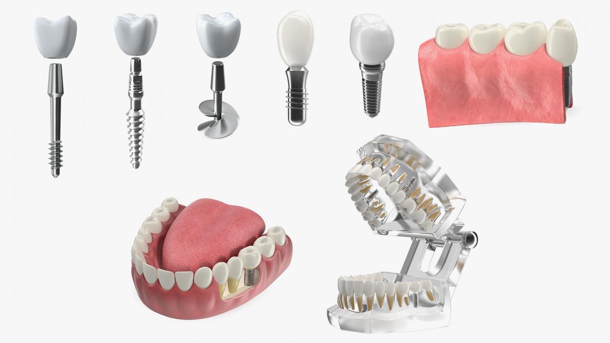 Tooth Implants Collection 2 3D