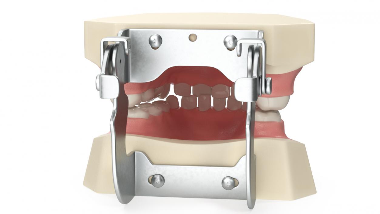 Dental Anatomy Model Simulation with Removable Crossbite Teeth 3D