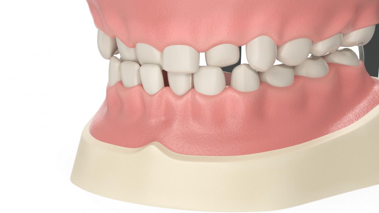 Dental Anatomy Model Simulation with Removable Crossbite Teeth 3D