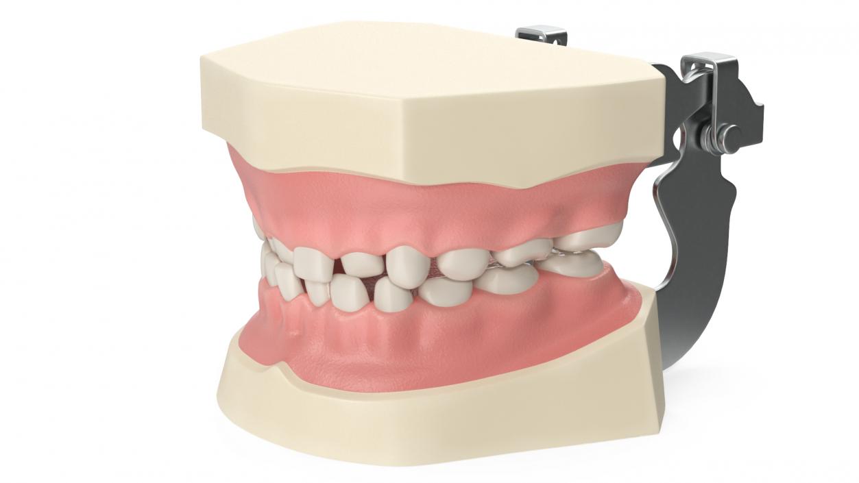 Dental Anatomy Model Simulation with Removable Crossbite Teeth 3D