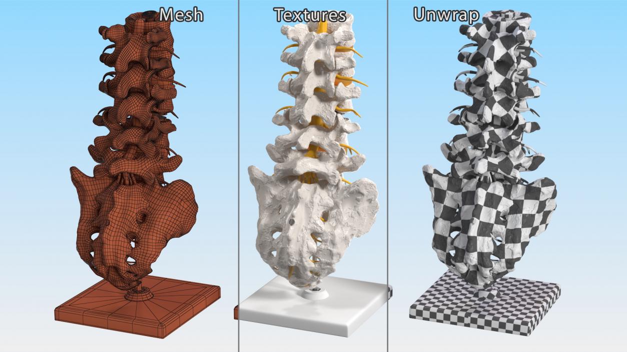 3D Intervertebral Disc Implant Installed on Spine 2 model